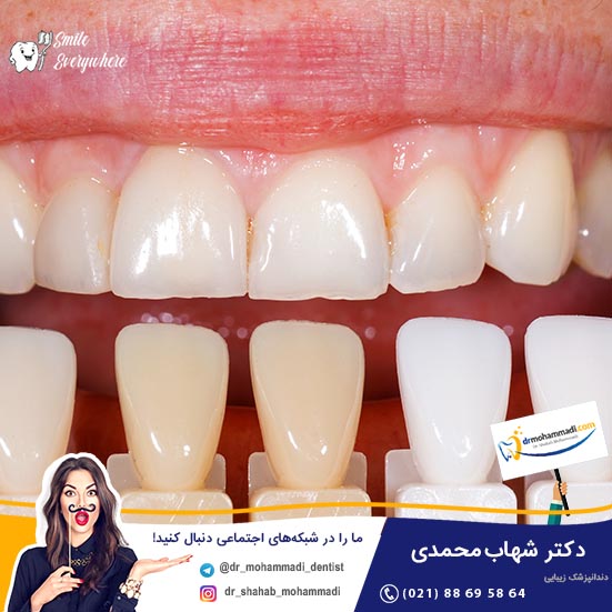 مراحل ترمیم کامپوزیت دندان شکسته چگونه است؟  - کلینیک دندانپزشکی دکتر شهاب محمدی